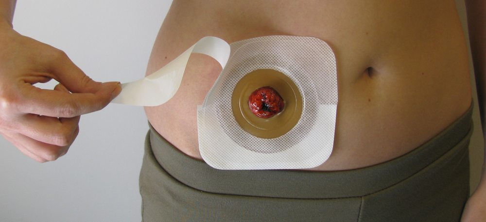 Esteem Synergy Versorgungswechsel &ndash; Schritt 06